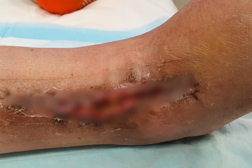 昆士兰洪水引发致命的黑热病疫情